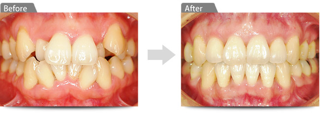 ビフォアー アフター