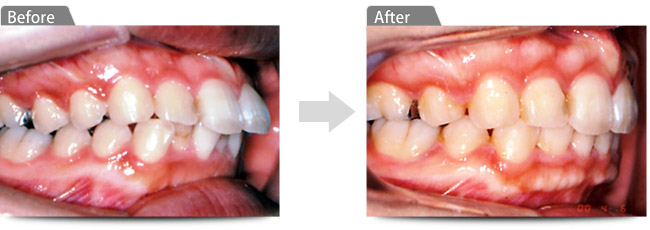 ビフォアー アフター