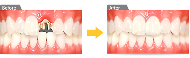 ヒューマンブリッジで治療した症例ビフォーアフター