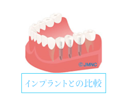 インプラントとの比較