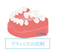 ブリッジとの比較