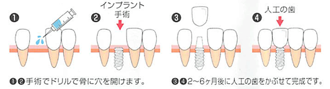 「インプラント治療」の流れ・メリット・デメリット図