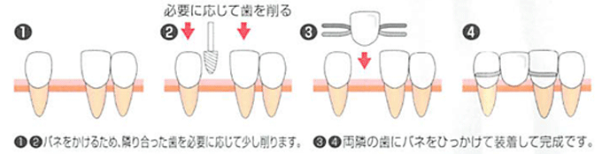 「入れ歯治療」の流れ・メリット・デメリット