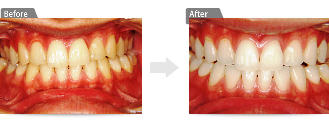 ビフォアー　アフター１