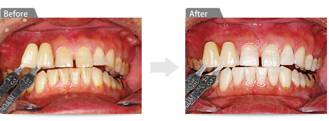 ビフォアー　アフター２
