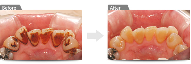 ビフォアー　アフター