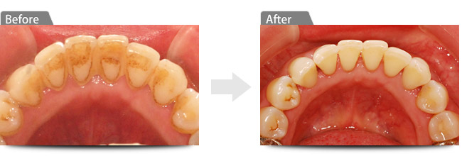 ビフォアー　アフター