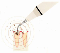 超音波スケーラー