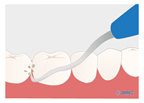 ハンドスケーラー