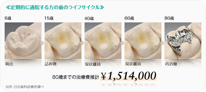 定期的に通院する方の歯のライフサイクル