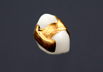 ゴールドインレー