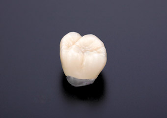 ゴールドメタボンド(奥歯)