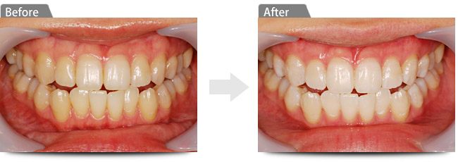ビフォアー　アフター