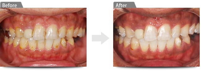 ビフォアー　アフター