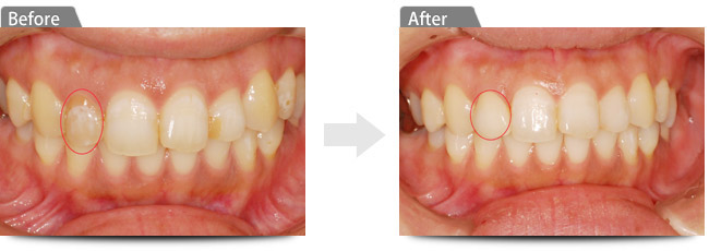 ビフォアー　アフター